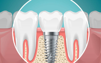 A Comprehensive Guide to Dental Implants in Clapham