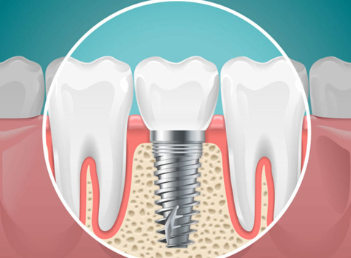 A Comprehensive Guide to Dental Implants in Clapham