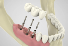 Dental Implant Procedures