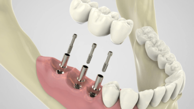 Dental Implant Procedures