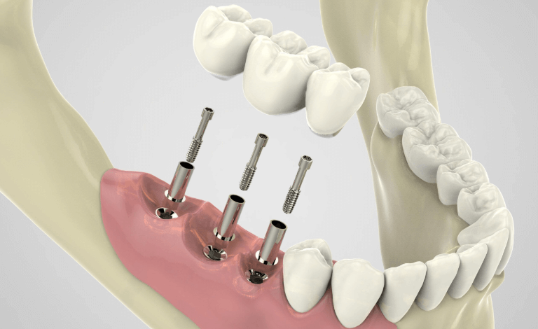 Dental Implant Procedures